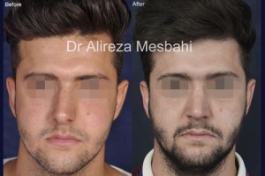 Rhinoplasty-105