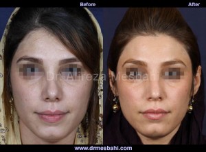 Rhinoplasty-60